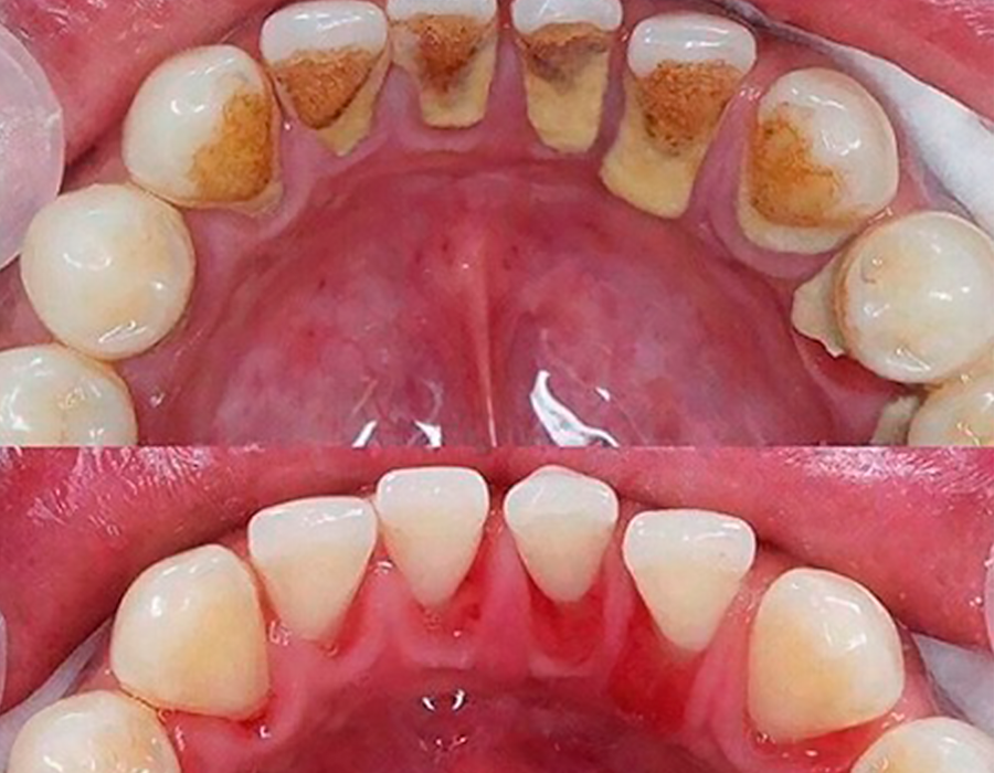 Dentista Pavuna 1 Limpeza-Dental